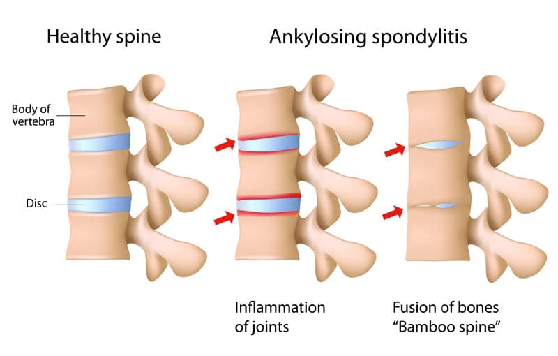 Ankylosing spondylitis of the spine Ankylosing spondylitis of the spine